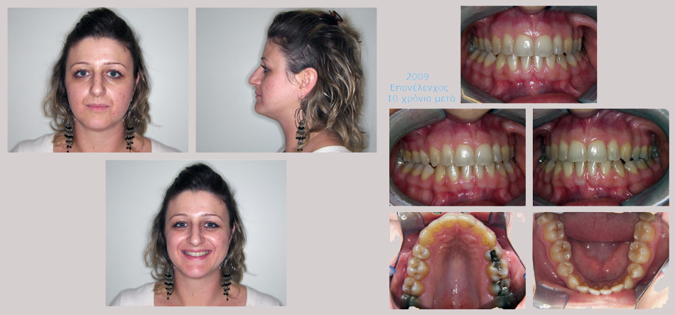 Συνωστισμος στην άνω και κάτω γνάθο και στένωση στην επάνω γνάθο. Θεραπεία εξαγωγών