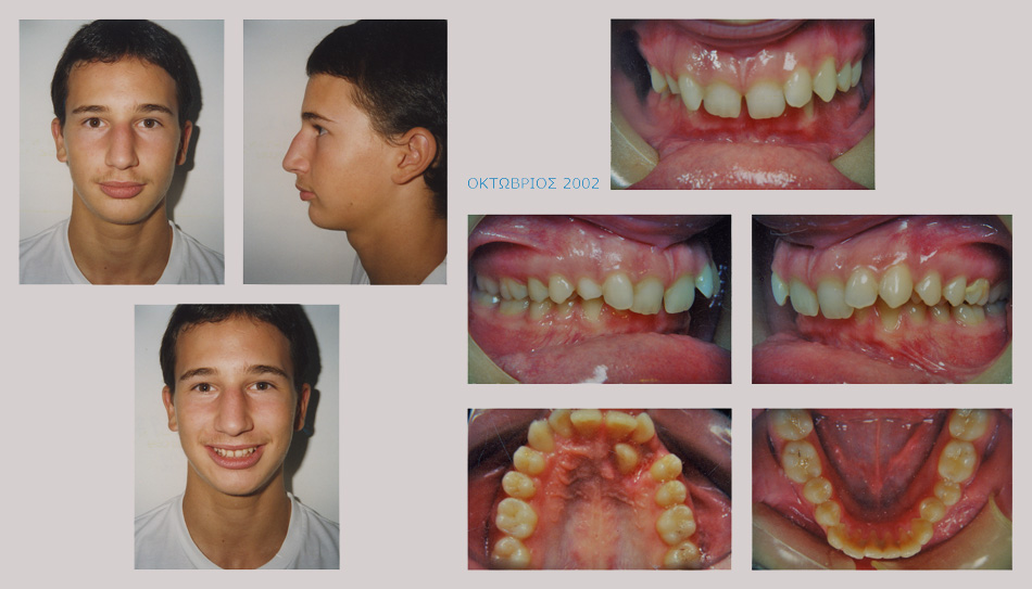 Συνωστισμός, υπερκάλυψη κάτω δοντιών και έγκλειστος κυνόδοντας στον ουρανίσκο. Θεραπεία εξαγωγών