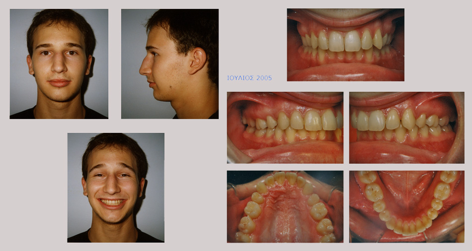 Συνωστισμός, υπερκάλυψη κάτω δοντιών και έγκλειστος κυνόδοντας στον ουρανίσκο. Θεραπεία εξαγωγών