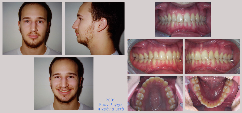 Συνωστισμός, υπερκάλυψη κάτω δοντιών και έγκλειστος κυνόδοντας στον ουρανίσκο. Θεραπεία εξαγωγών