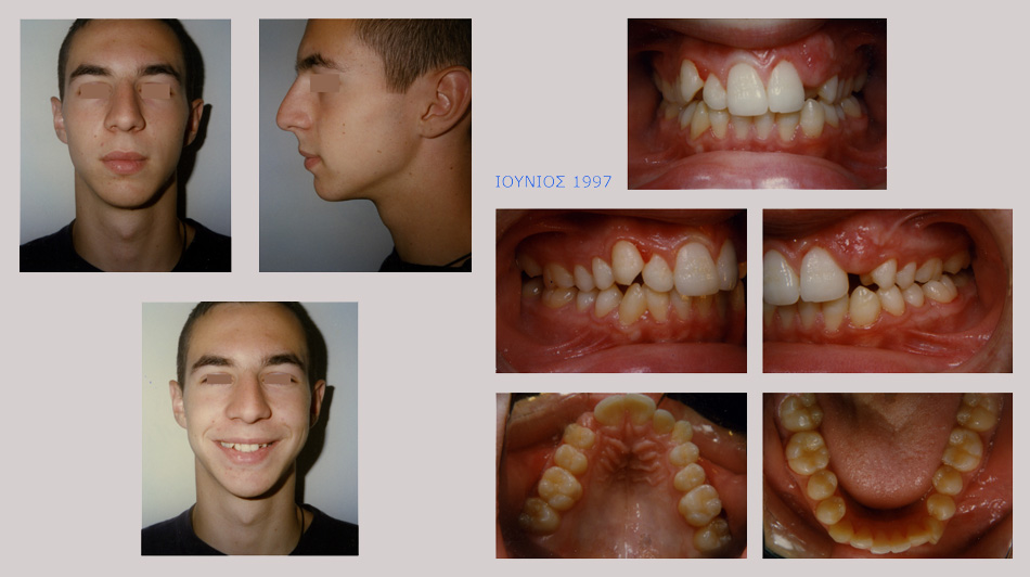 Συνωστισμοί, ασυμετρία, έγκλειστος κυνόδοντας στην άνω γνάθο