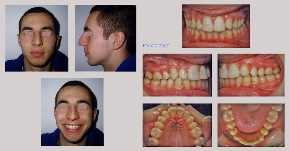 Συνωστισμοί, ασυμετρία, έγκλειστος κυνόδοντας στην άνω γνάθο