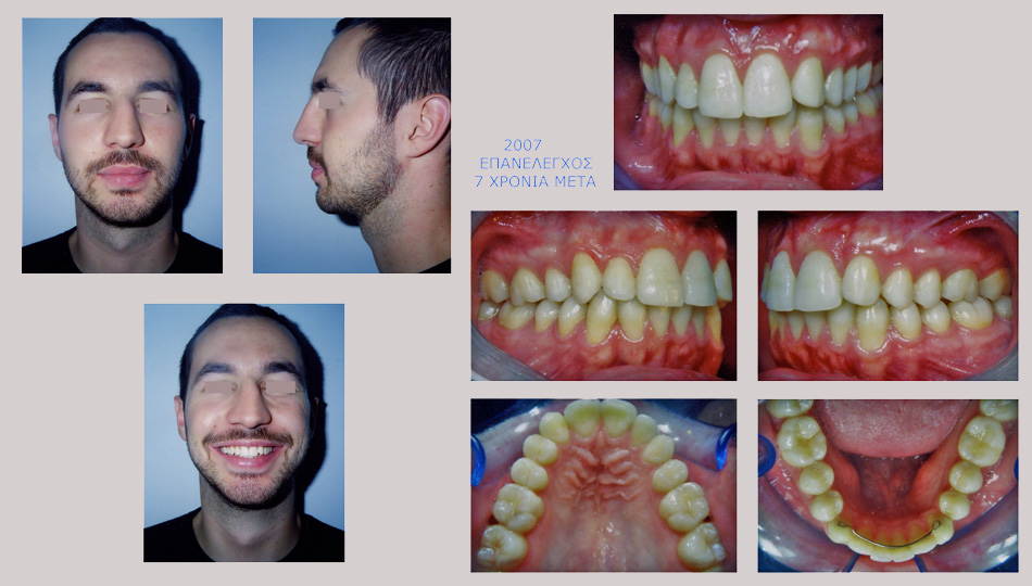 Συνωστισμοί, ασυμετρία, έγκλειστος κυνόδοντας στην άνω γνάθο