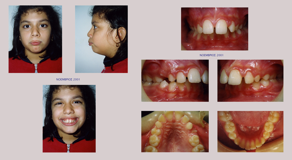 Στένωση άνω γνάθου, υπερκάλυψη κάτω δοντιών, οπισθογναθισμός της κάτω γνάθου