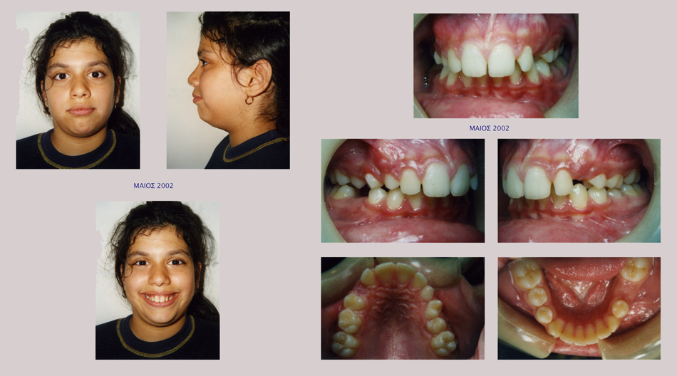 Στένωση άνω γνάθου, υπερκάλυψη κάτω δοντιών, οπισθογναθισμός της κάτω γνάθου
