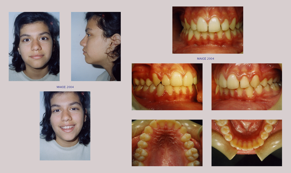 Στένωση άνω γνάθου, υπερκάλυψη κάτω δοντιών, οπισθογναθισμός της κάτω γνάθου
