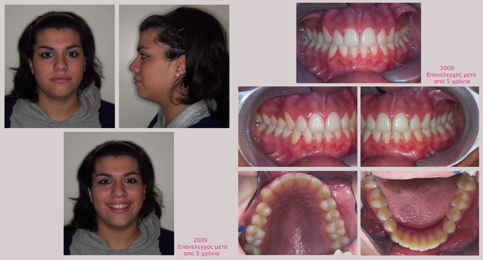 Στένωση άνω γνάθου, υπερκάλυψη κάτω δοντιών, οπισθογναθισμός της κάτω γνάθου