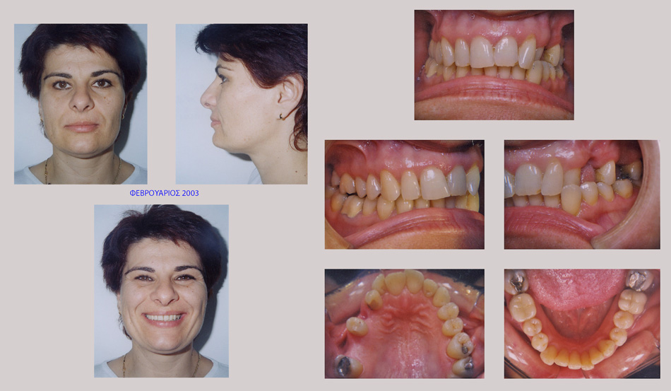 Ορθοδοντικά προβλήματα και απώλεις δοντιων. Ορθοδοντική - προσθετική θεραπεία