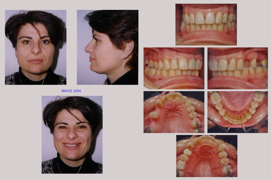 Ορθοδοντικά προβλήματα και απώλεις δοντιων. Ορθοδοντική - προσθετική θεραπεία