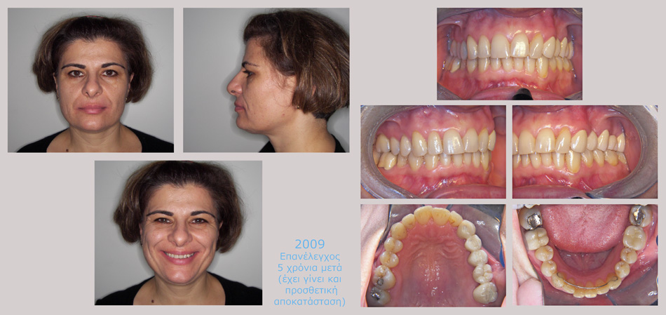 Ορθοδοντικά προβλήματα και απώλεις δοντιων. Ορθοδοντική - προσθετική θεραπεία