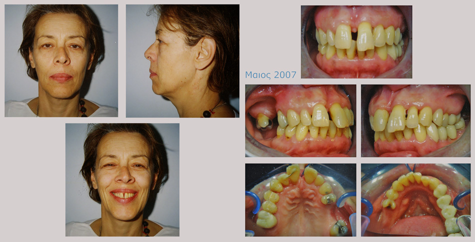 Περιοδοντική νόσος με μετακινήσεις δοντιών. Περιοδοντική-Ορθοδοντική-Προσθετική θεραπεία