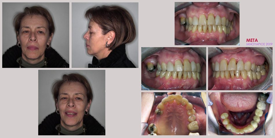 Περιοδοντική νόσος με μετακινήσεις δοντιών. Περιοδοντική-Ορθοδοντική-Προσθετική θεραπεία
