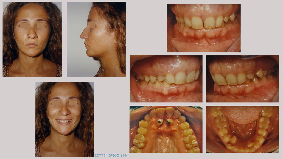 Υπερκάλυψη των κάτω προσθίων δοντιών