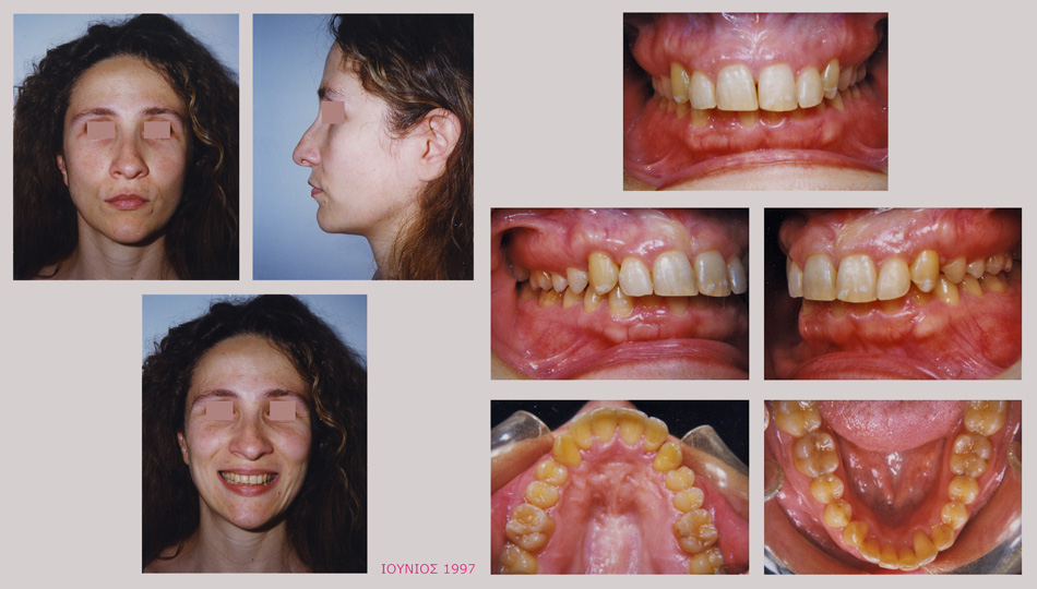 Υπερκάλυψη των κάτω προσθίων δοντιών