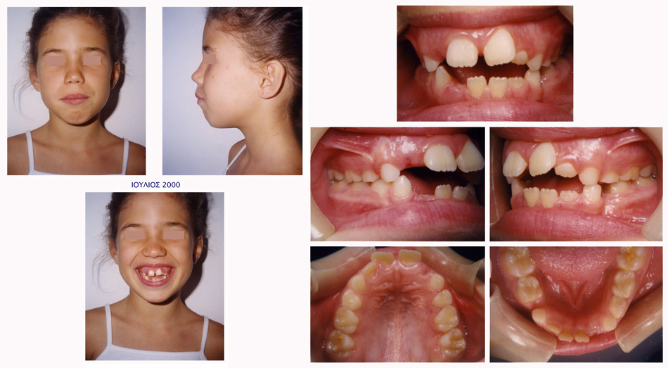 Διακοπή προώθησης γλώσσας - Ορθοδοντικός Δρ. Ζαρμπή