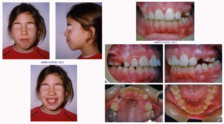 Διακοπή προώθησης γλώσσας - Ορθοδοντικός Δρ. Ζαρμπή