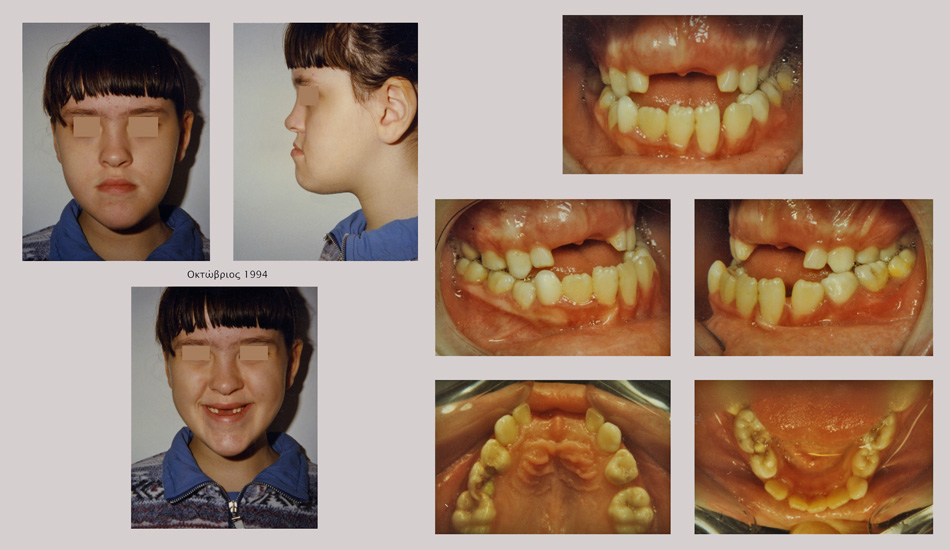 Βαρύτατος προγναθισμός της κάτω γνάθου με υποπλασία της άνω γνάθου