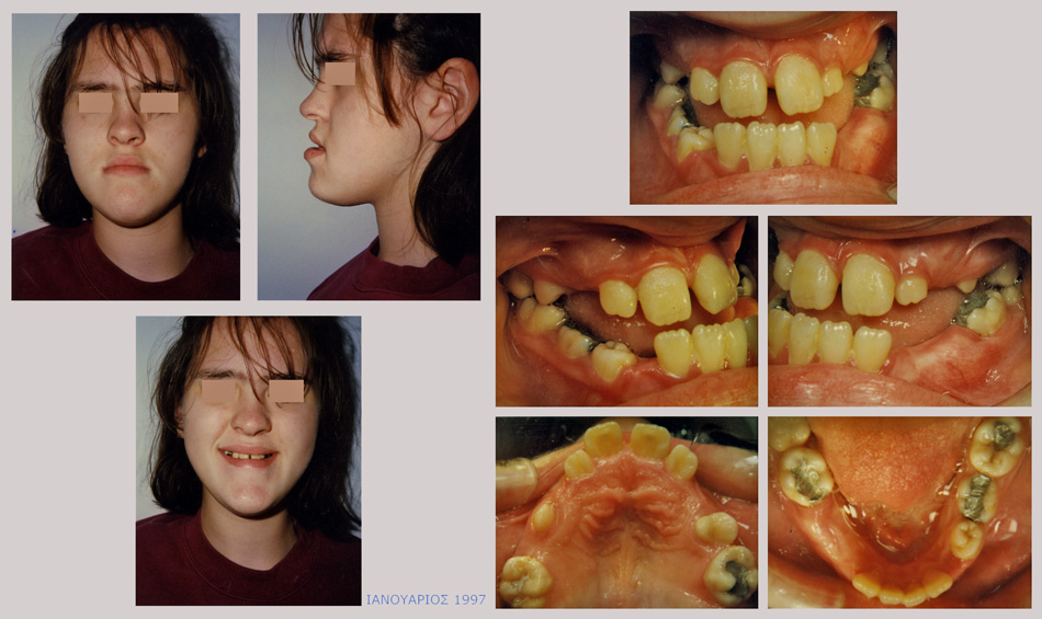 Βαρύτατος προγναθισμός της κάτω γνάθου με υποπλασία της άνω γνάθου