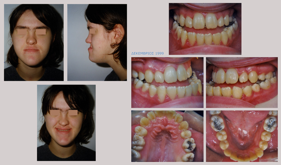 Βαρύτατος προγναθισμός της κάτω γνάθου με υποπλασία της άνω γνάθου