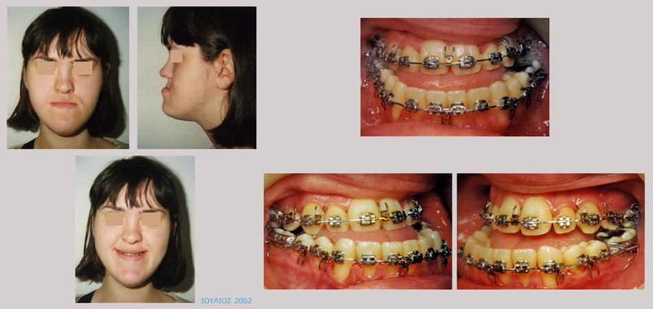 Βαρύτατος προγναθισμός της κάτω γνάθου με υποπλασία της άνω γνάθου