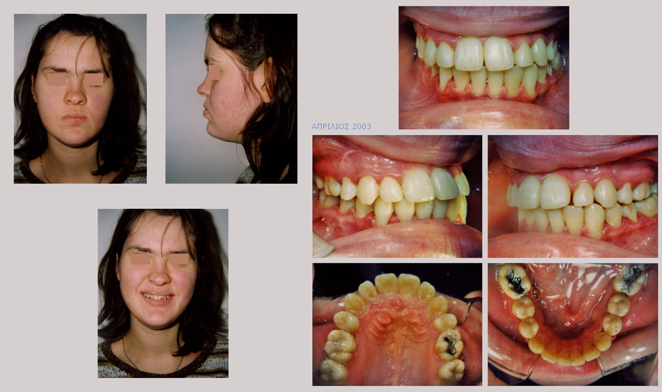 Βαρύτατος προγναθισμός της κάτω γνάθου με υποπλασία της άνω γνάθου