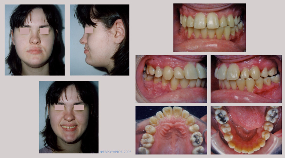 Βαρύτατος προγναθισμός της κάτω γνάθου με υποπλασία της άνω γνάθου