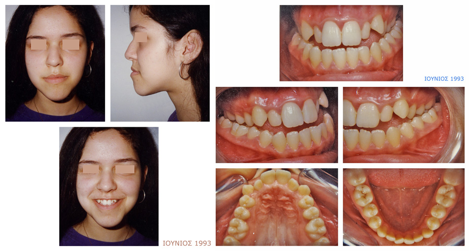 Στένωση και συνωστισμός στην άνω γνάθο - Προχειρουργική ορθοδοντική - Ορθοδοντικός Δρ. Ζαρμπή