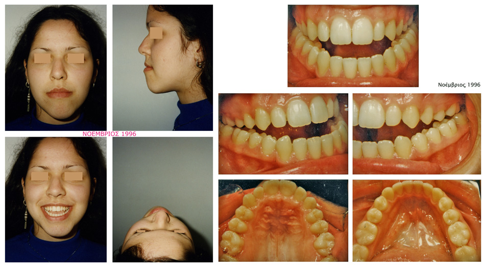 Στένωση και συνωστισμός στην άνω γνάθο - Μεταχειρουργική ορθοδοντική θεραπεία - Ορθοδοντικός Δρ. Ζαρμπή