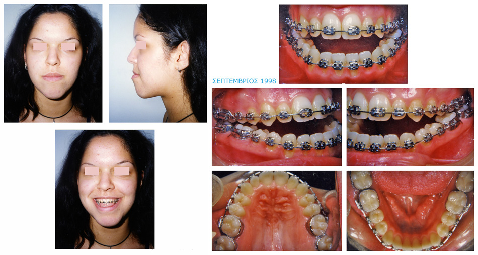 Στένωση και συνωστισμός στην άνω γνάθο - Χειρουργική επέμβαση - Ορθοδοντικός Δρ. Ζαρμπή