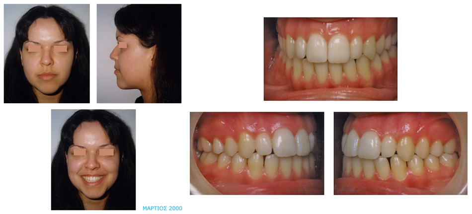 Στένωση και συνωστισμός στην άνω γνάθο - Μεταχειρουργική ορθοδοντική θεραπεία - Ορθοδοντικός Δρ. Ζαρμπή