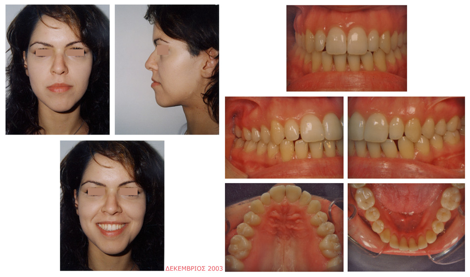 Στένωση και συνωστισμός στην άνω γνάθο - Ορθοδοντική Θεραπεία Δρ. Ζαρμπή