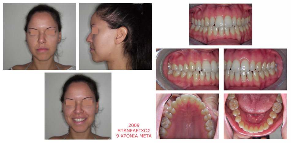 Στένωση και συνωστισμός στην άνω γνάθο - Ορθοδοντική Θεραπεία Δρ. Ζαρμπή