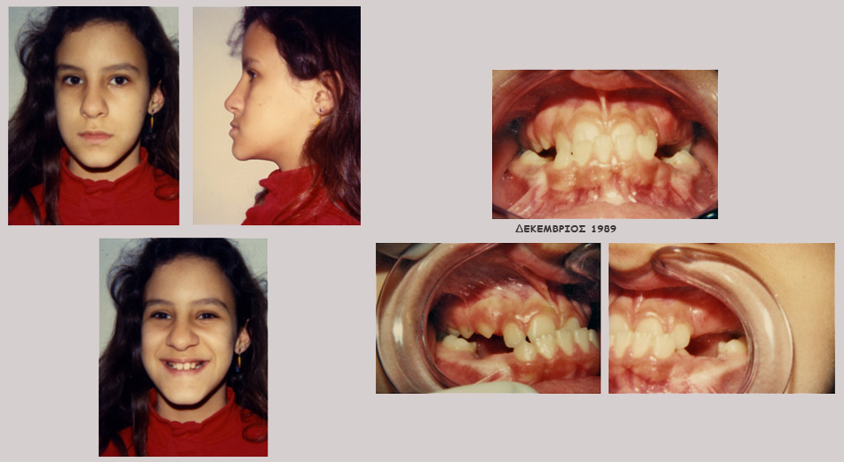 Έντονος προγναθισμός κάτω γνάθου - Ορθοδοντική Θεραπεία Δρ. Ζαρμπή