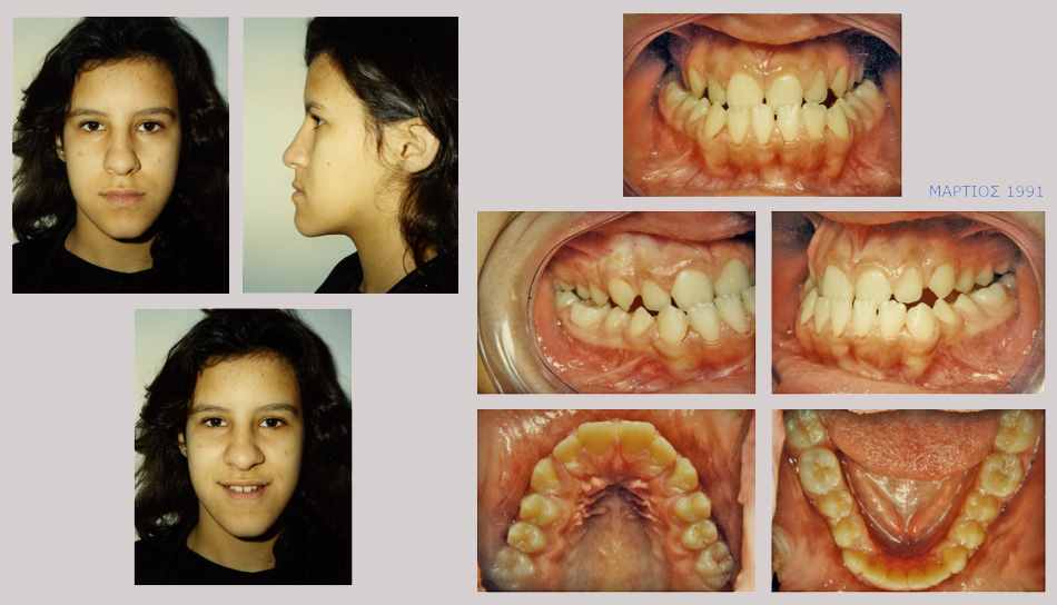 Έντονος προγναθισμός κάτω γνάθου - Ορθοδοντική Θεραπεία Δρ. Ζαρμπή