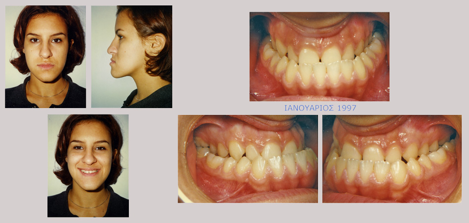 Έντονος προγναθισμός κάτω γνάθου - Ορθοδοντική Θεραπεία Δρ. Ζαρμπή