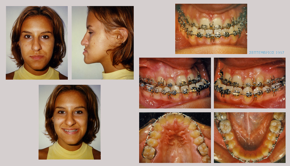 Έντονος προγναθισμός κάτω γνάθου - Ορθοδοντική Θεραπεία Δρ. Ζαρμπή