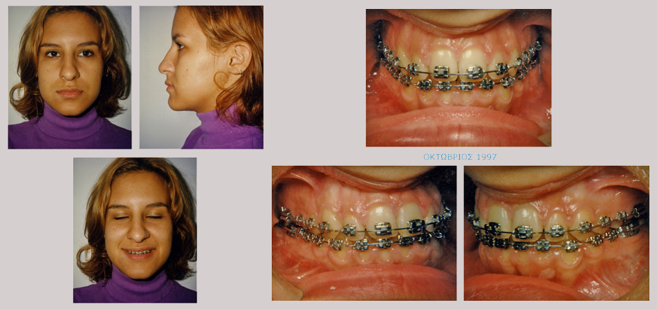 Έντονος προγναθισμός κάτω γνάθου - Ορθοδοντική Θεραπεία Δρ. Ζαρμπή