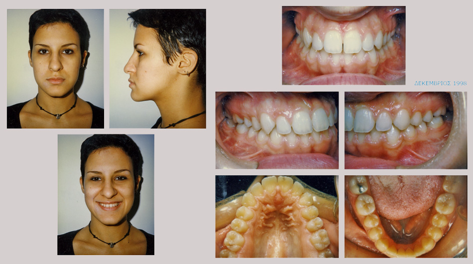 Έντονος προγναθισμός κάτω γνάθου - Ορθοδοντική Θεραπεία Δρ. Ζαρμπή