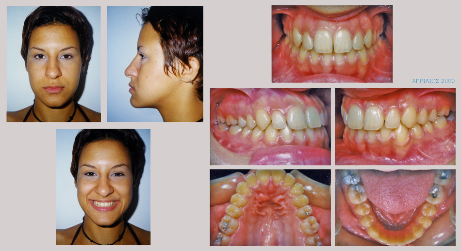 Έντονος προγναθισμός κάτω γνάθου - Ορθοδοντική Θεραπεία Δρ. Ζαρμπή