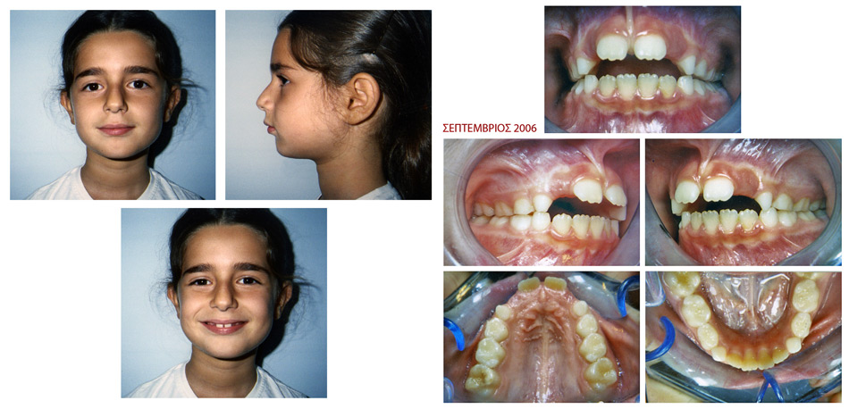 Διόρθωση στένωσης άνω γνάθου - Ορθοδοντικός Δρ. Ζαρμπή