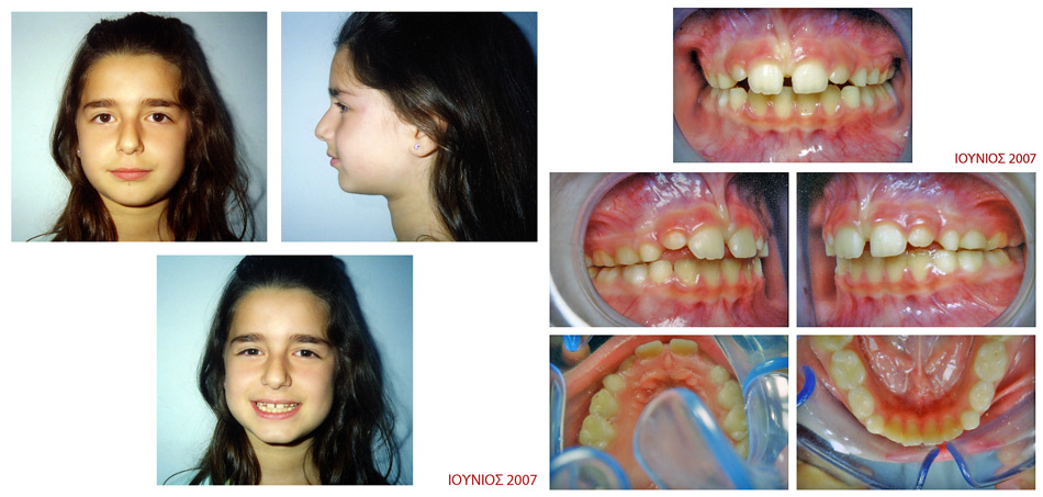 Διόρθωση στένωσης άνω γνάθου - Ορθοδοντικός Δρ. Ζαρμπή