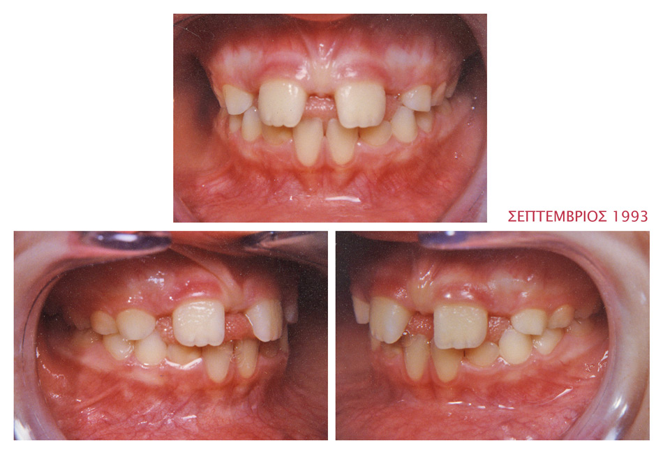 Διάστημα μεταξύ των επάνω δοντιών - Ορθοδοντικός Δρ. Ζαρμπή