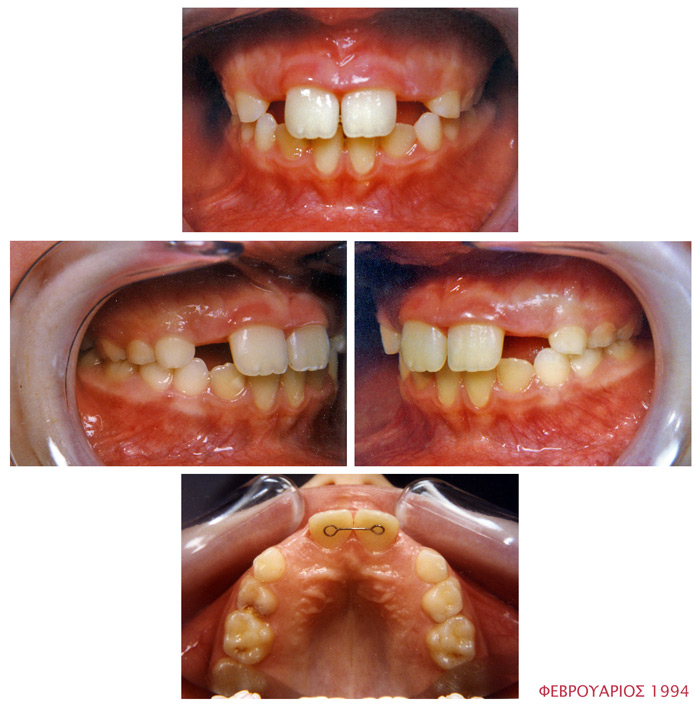 Διάστημα μεταξύ των επάνω δοντιών - Ορθοδοντικός Δρ. Ζαρμπή