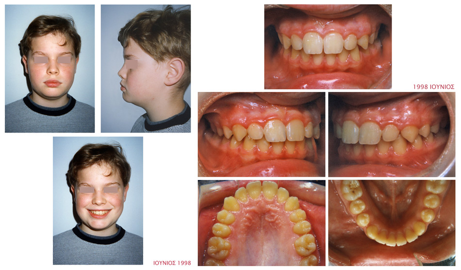 Διάστημα μεταξύ των επάνω δοντιών - Ορθοδοντικός Δρ. Ζαρμπή