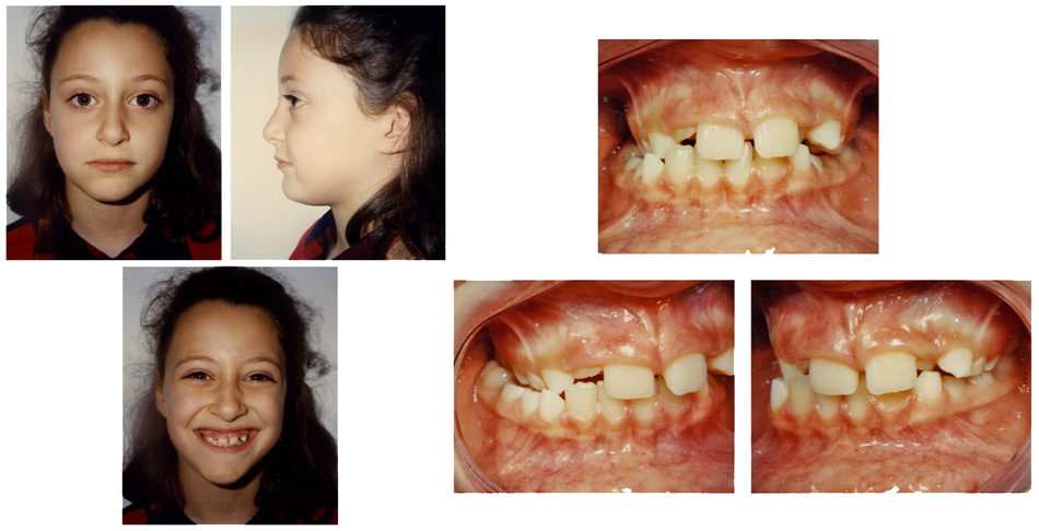 Στένωση, ασσυμετρία, συνωστισμός - Ορθοδοντικός Δρ. Ζαρμπή