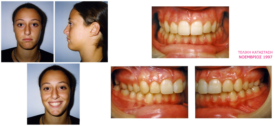 Στένωση, ασσυμετρία, συνωστισμός - Ορθοδοντικός Δρ. Ζαρμπή