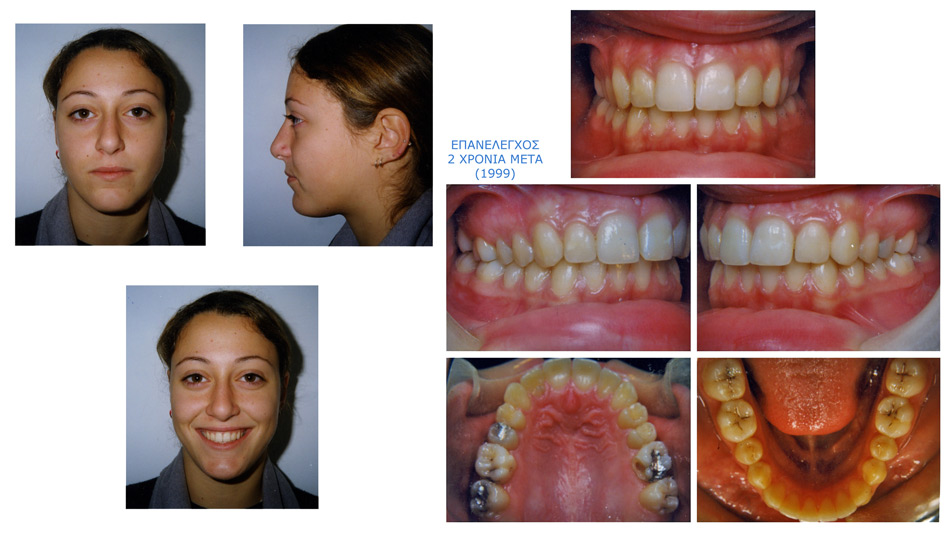 Στένωση, ασσυμετρία, συνωστισμός - Ορθοδοντικός Δρ. Ζαρμπή