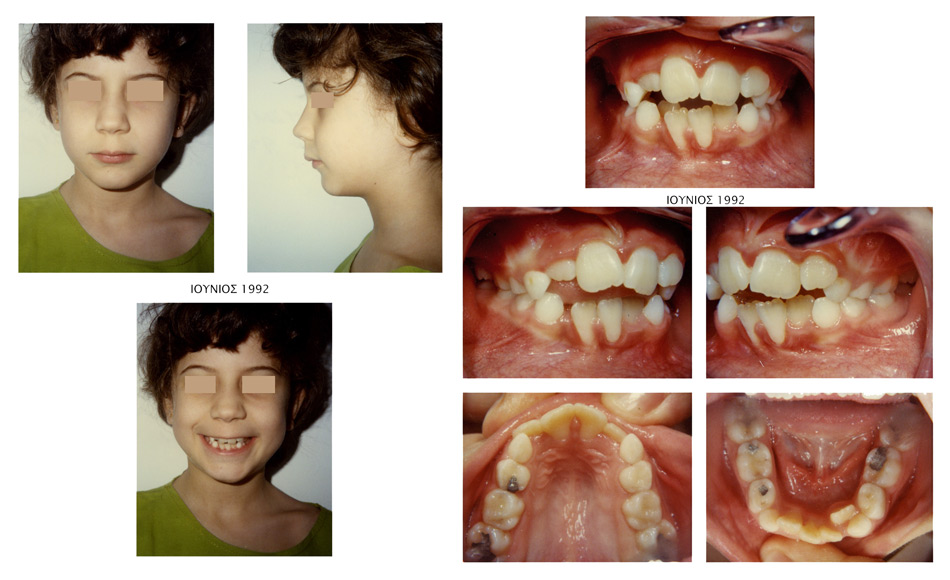 Έντονοι συνωστισμοί και οπισθογναθισμός κάτω γνάθου - Ορθοδοντικός Δρ. Ζαρμπή