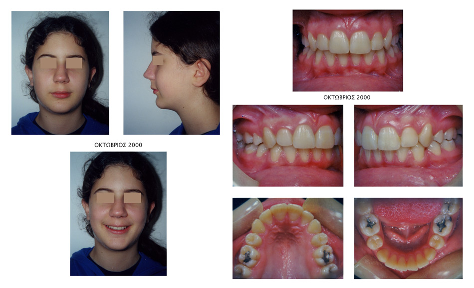 Έντονοι συνωστισμοί και οπισθογναθισμός κάτω γνάθου - Ορθοδοντικός Δρ. Ζαρμπή