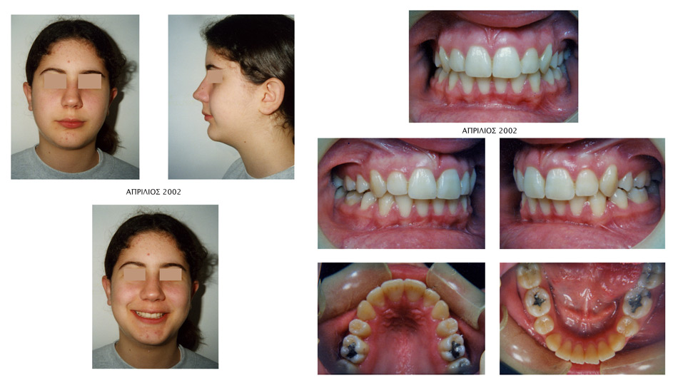 Έντονοι συνωστισμοί και οπισθογναθισμός κάτω γνάθου - Ορθοδοντικός Δρ. Ζαρμπή